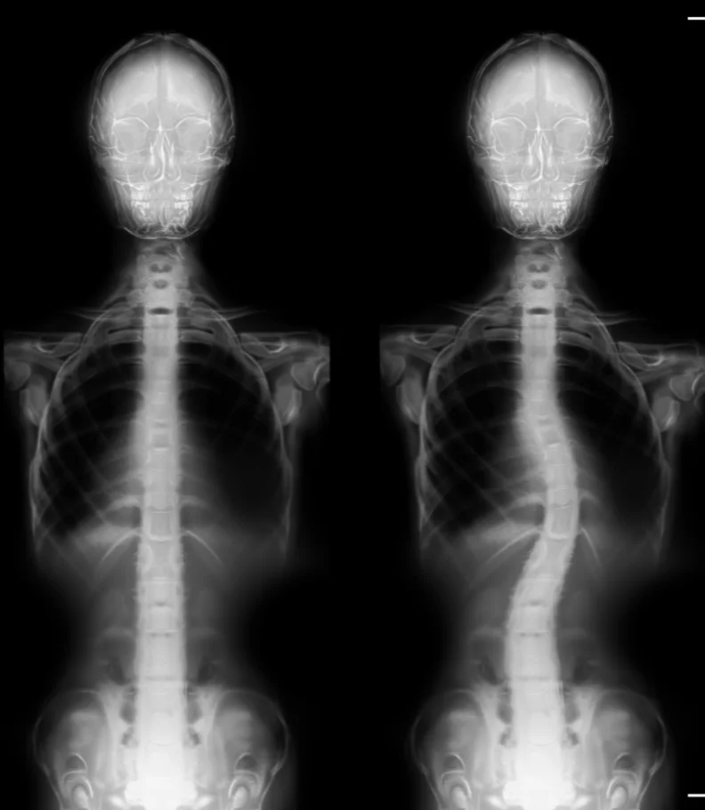 scoliosis Ogden IA